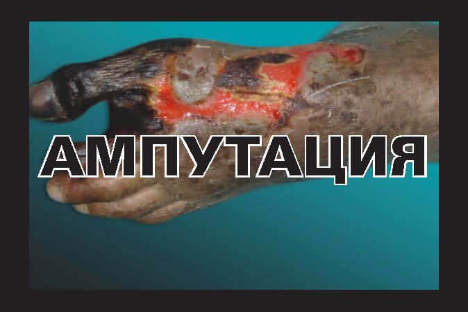 Krievija smēķētājus baidīs ar gangrēnu